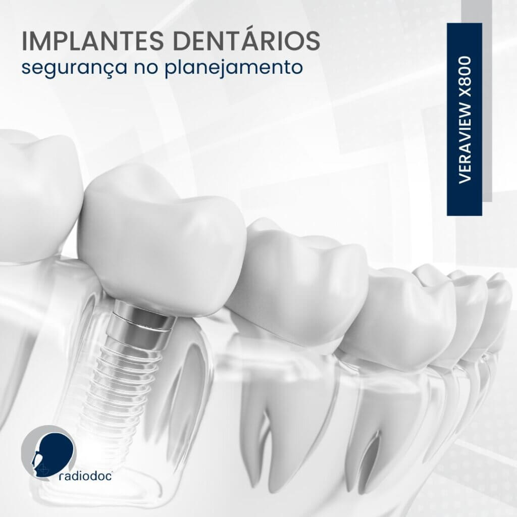 Ilustração de implantes dentários