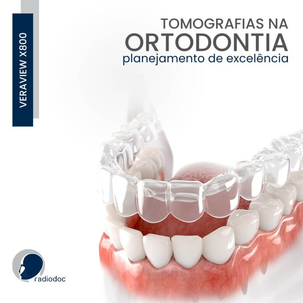 Ilustração de alinhadores transparentes sendo colocados sobre a arcada inferior