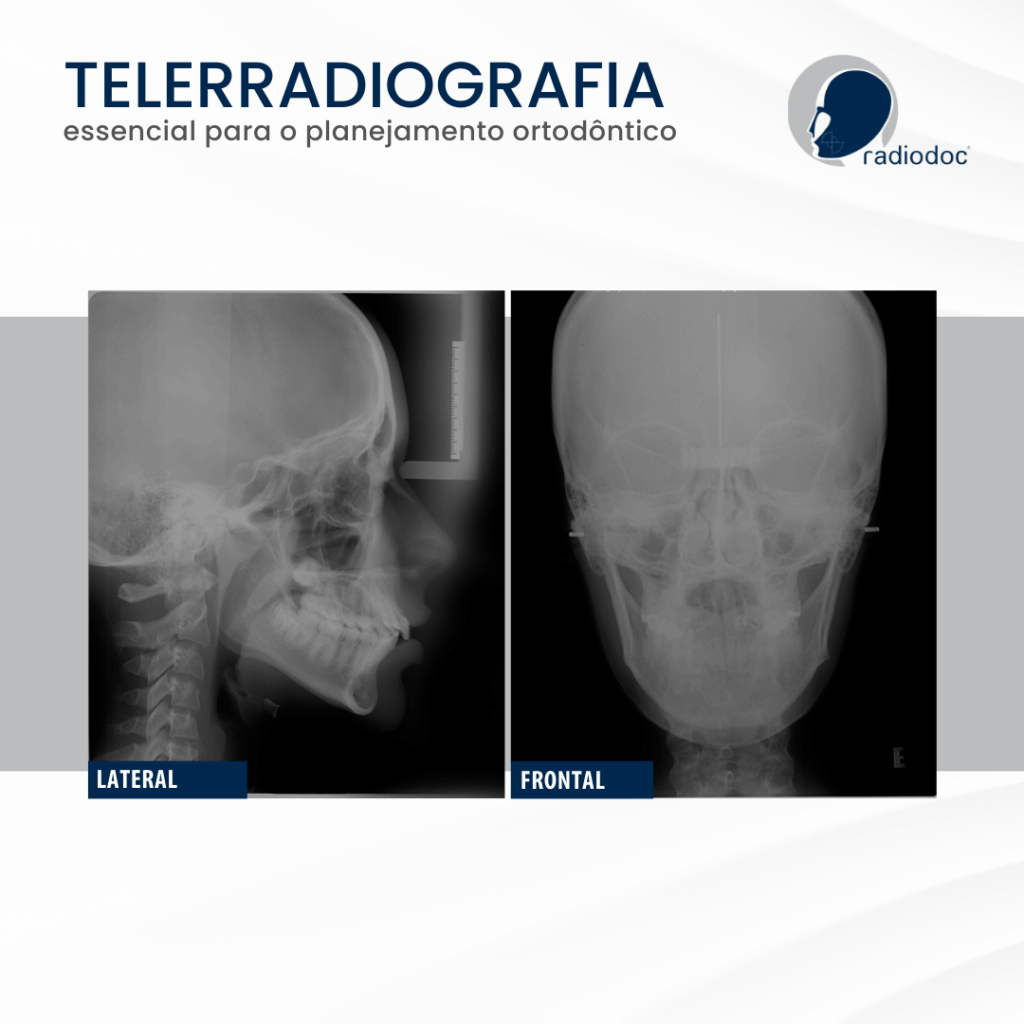 Telerradiografias laterial e frontal