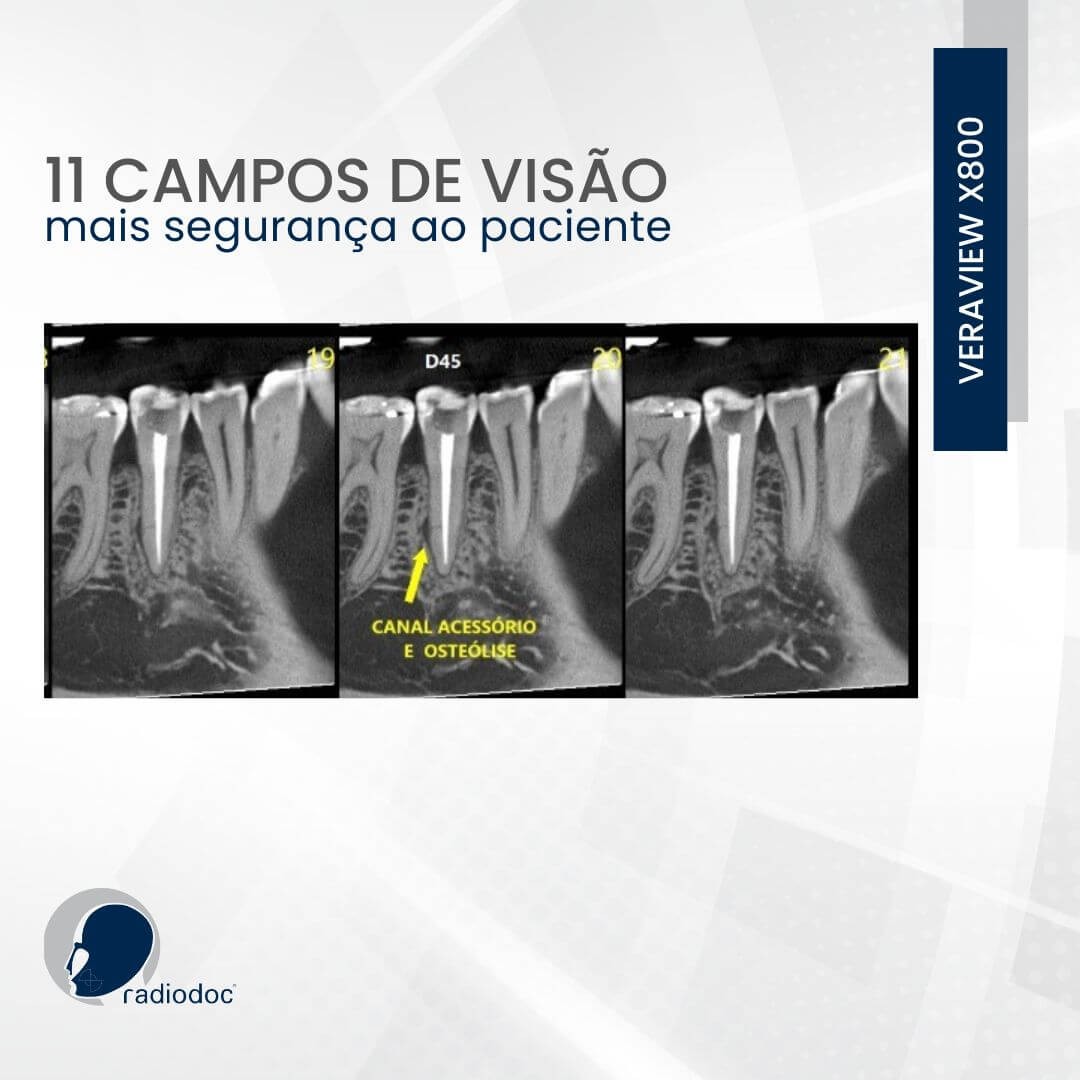 Imagens tomográficas de alguns campos de visão do Veraview X800