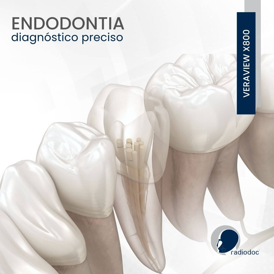 Endodontia – Diagnóstico Preciso