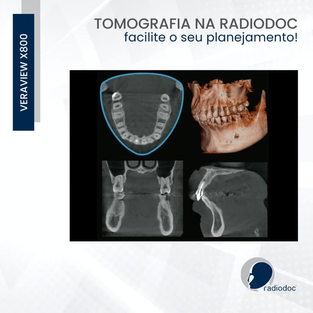 Imagens tomográficas de alta resolução