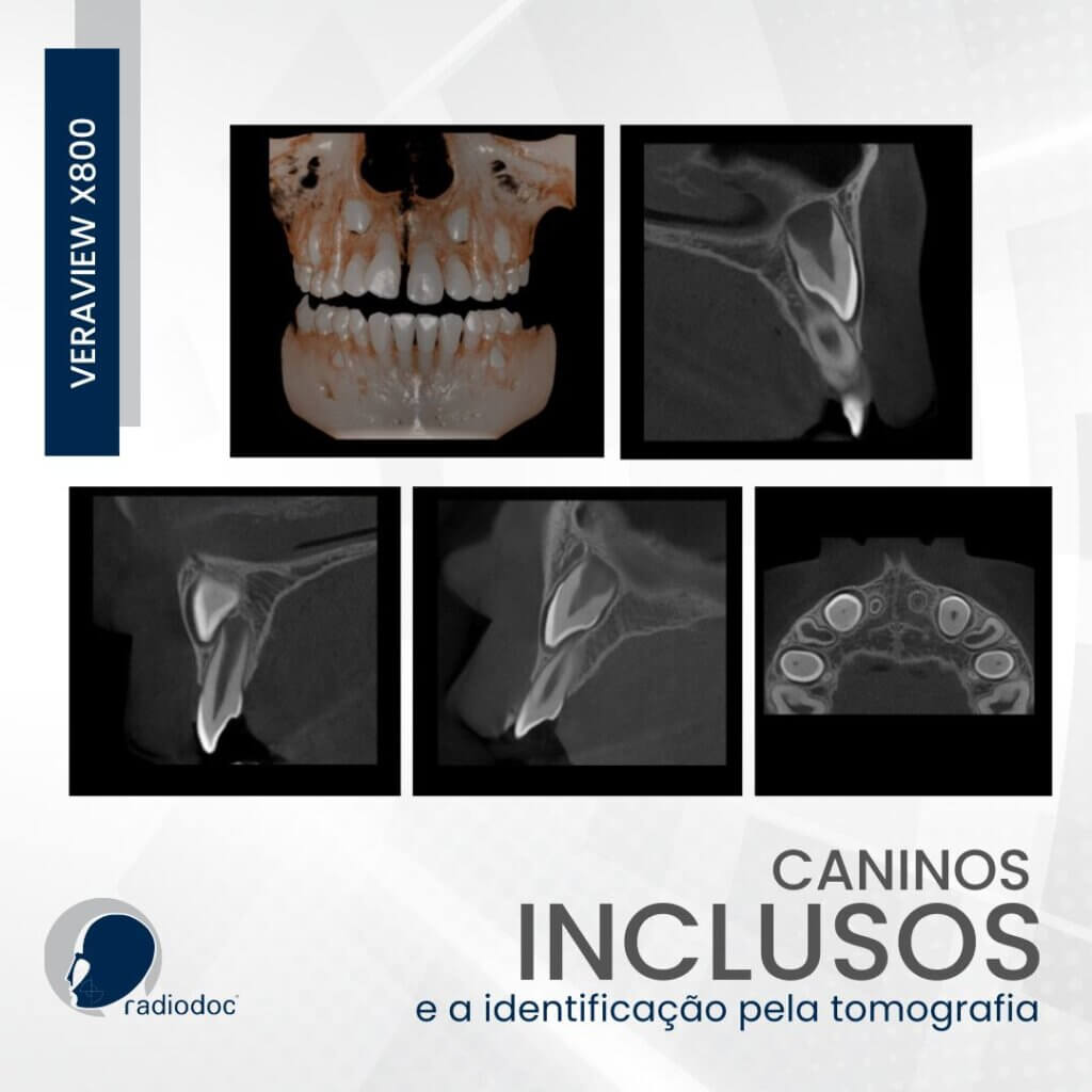 Imagens tomográficas revelando caninos inclusos